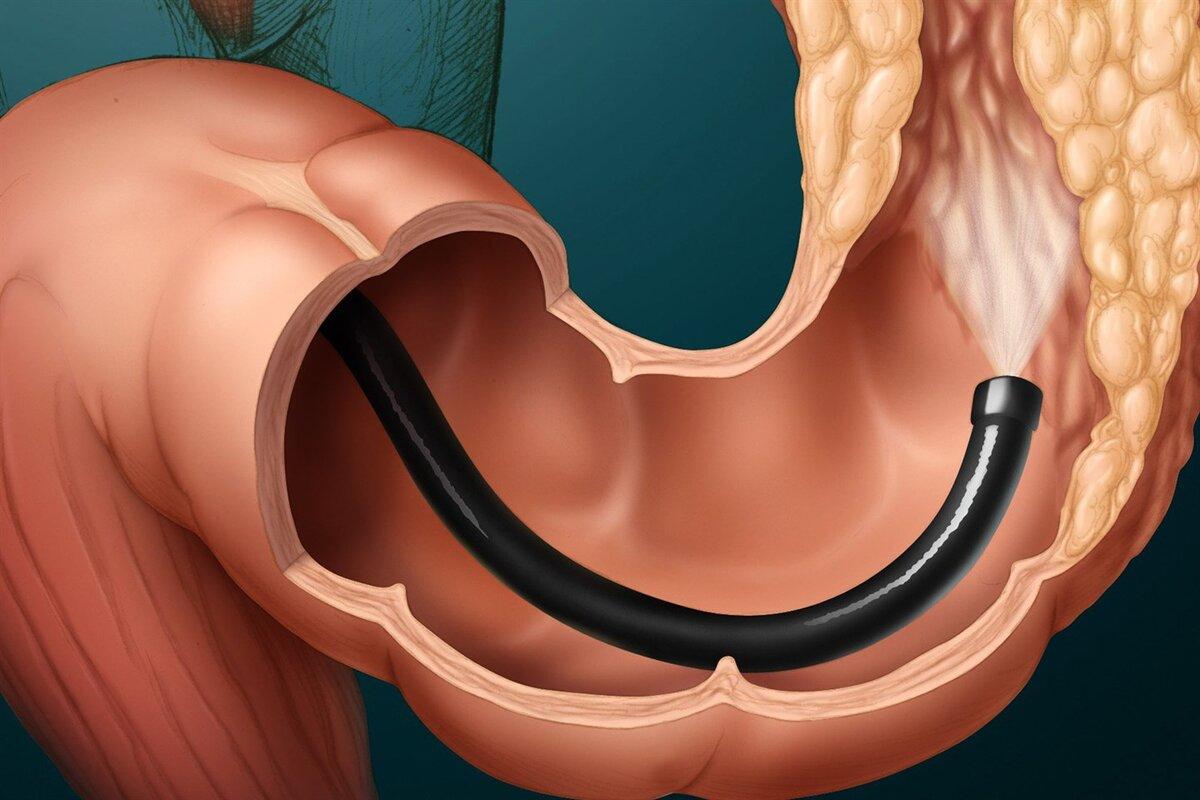 Как подготовиться к колоноскопии - Городская клиническая больница №1 -  Городская клиническая больница №1